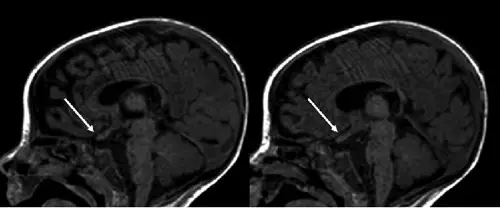 Krabbe Disease