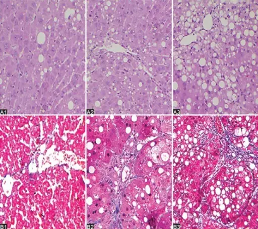 LIVER PATHOLOGY