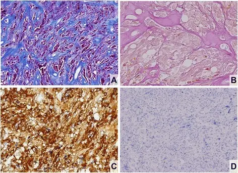 Lactotroph Adenomas