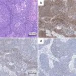 Lambert-Eaton Myasthenic Syndrome