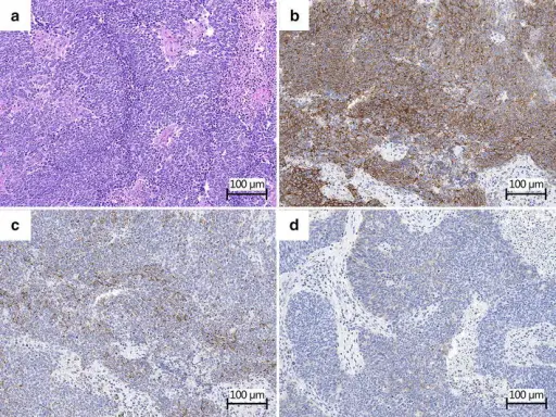 Lambert-Eaton Myasthenic Syndrome