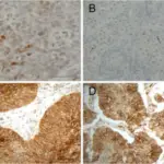 Large Cell Carcinoma of the Lung