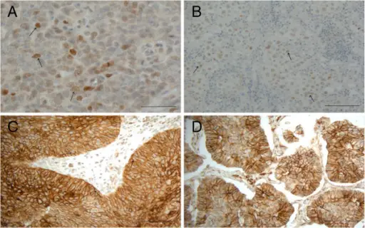 Large Cell Carcinoma of the Lung