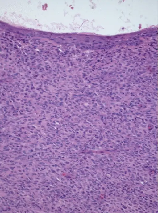 Melanoma of the larynx