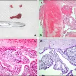 Lateral Periodontal Cyst