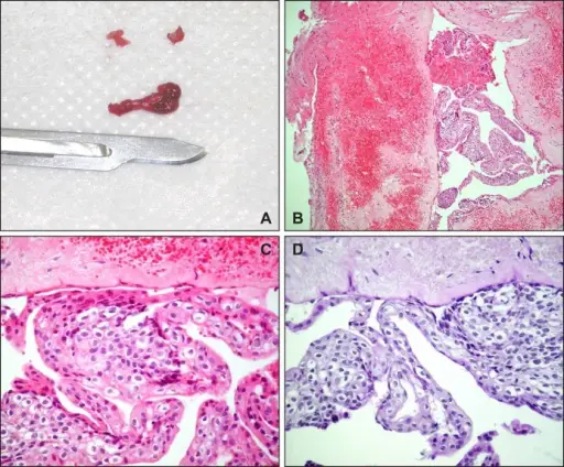 Lateral Periodontal Cyst