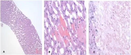 Left-Sided Heart Failure