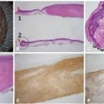 Leiomyoma