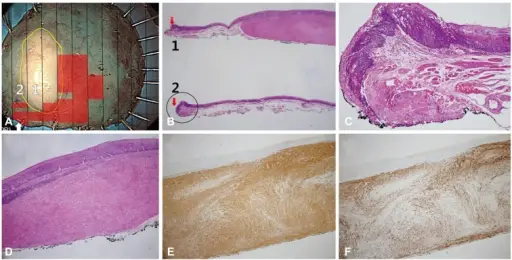 Leiomyoma