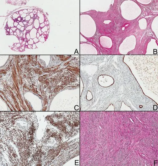 Leiomyoma