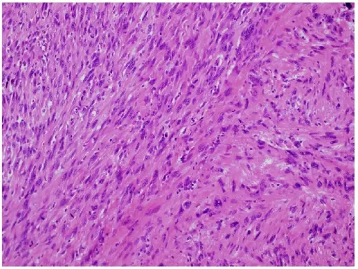 Leiomyosarcoma