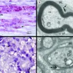 Leprosy (Hansen Disease) Infectious Neuropathy