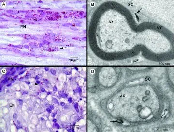 Leprosy (Hansen Disease) Infectious Neuropathy