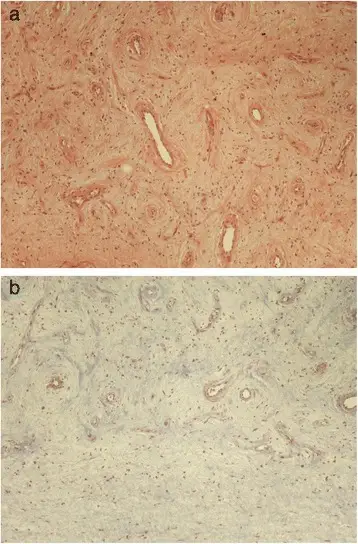 Lesions of Tunica Vaginalis