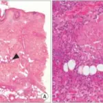 Leukocytosis