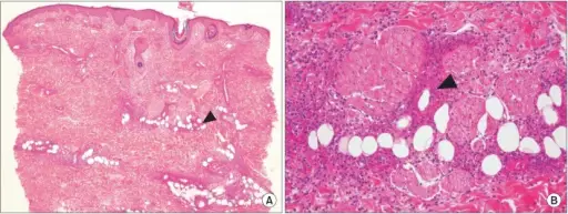 Leukocytosis