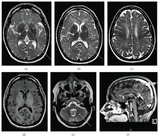 Leukodystrophies