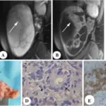 Leydig Cell Tumors