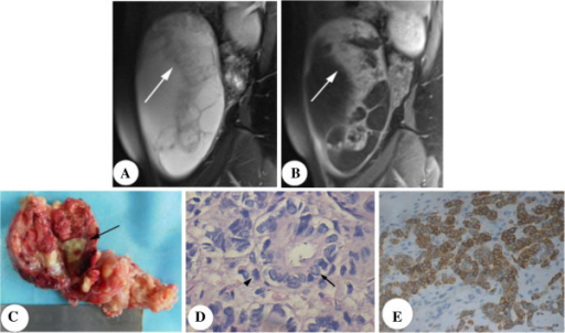 Leydig Cell Tumors