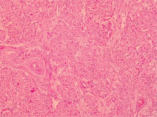 Leydig Cell Tumors