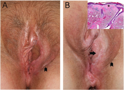 Lichen Sclerosus of the Vulva