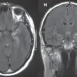 Limbic Encephalitis