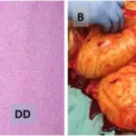 Liposarcoma