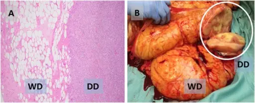 Liposarcoma