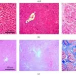 Liver Failure Related Disorder of Hemostasis