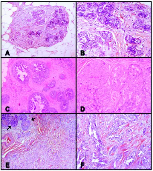 Lobular Carcinoma in Situ