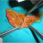 Longitudinal Septum of the Gallbladder