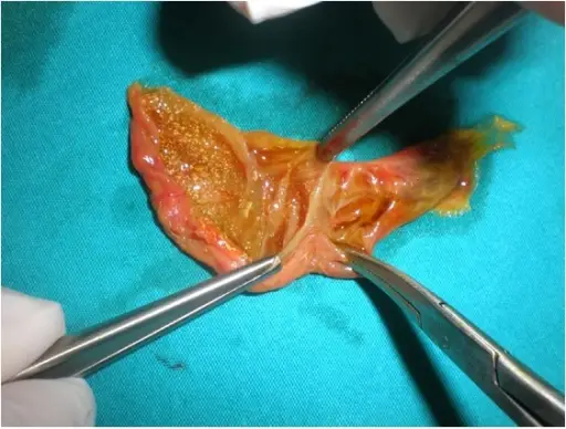 Longitudinal Septum of the Gallbladder