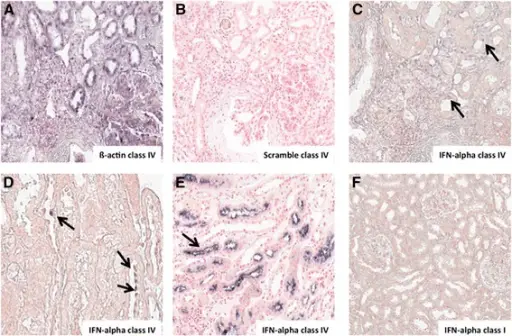 Lupus Nephritis