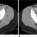 Luteal Cysts of the Ovary