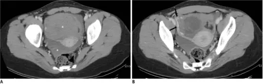 Luteal Cysts of the Ovary