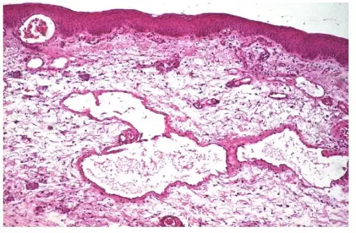 Lymphangiomas