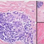 Lymphocytic Mastopathy