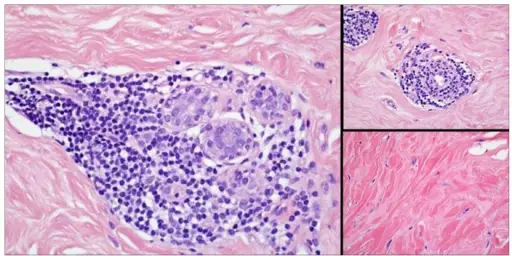 Lymphocytic Mastopathy