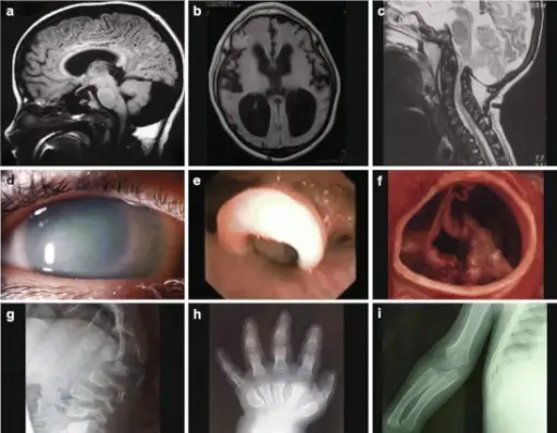 Lysosomal Storage Diseases