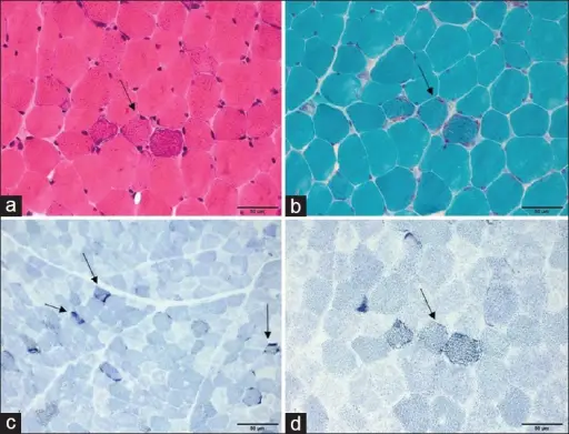 MUSCLE PATHOLOGY