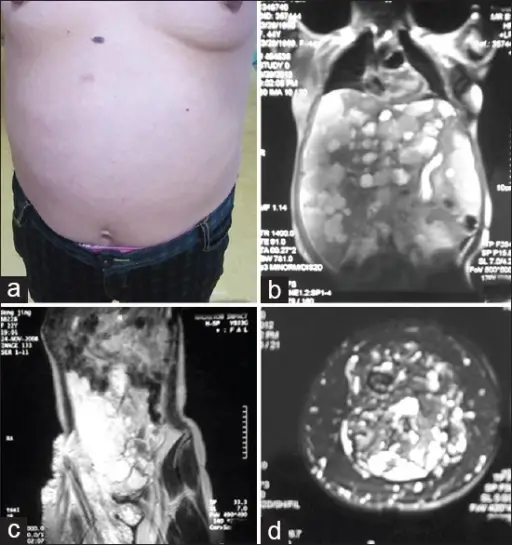 Malformation Syndrome