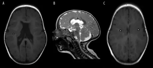 Malformations and Developmental Disorders of the Central Nervous System