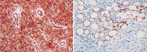 Malignant Adipose Soft Tissue Tumors