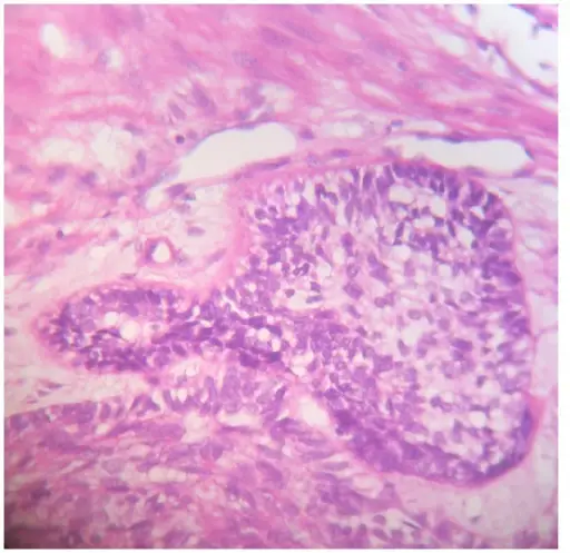 Malignant Ameloblastoma