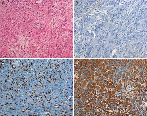 Malignant Fibrous Histiocytoma