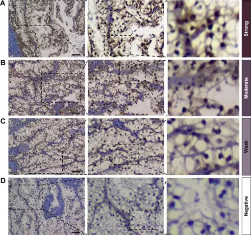 Malignant Kidney Neoplasms