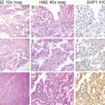 Malignant Mesothelioma