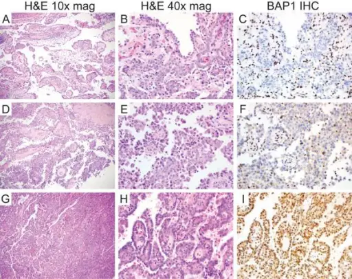 Malignant Mesothelioma