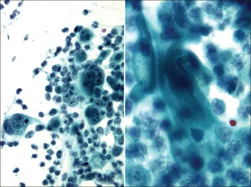 Malignant Mixed Mullerian Tumors