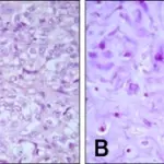 Malignant Mixed Tumor